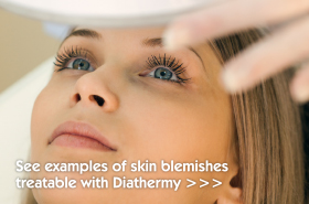 Blemishes Treatable with Diathermy