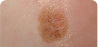 Skin Lesions